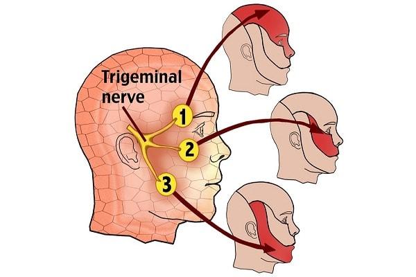 Các cách điều trị bệnh đau dây thần kinh số V
