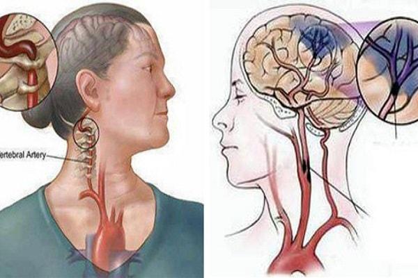 Hướng điều trị bệnh tai biến mạch máu não hiệu quả