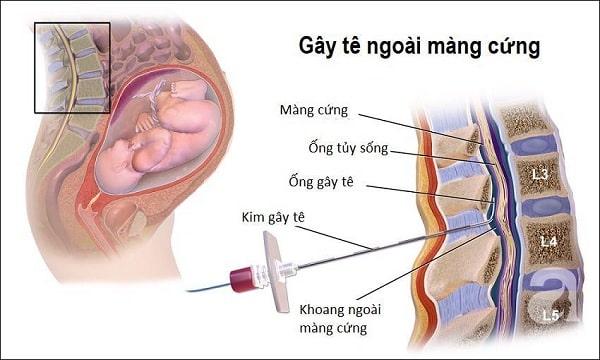 Phương pháp điều trị gây tê ngoài màng cứng