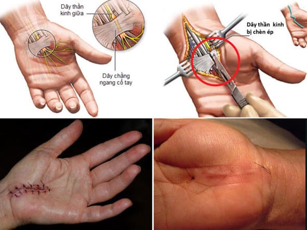 Biện pháp phẫu thuật hội chứng ống cổ tay