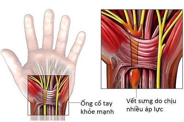 Nguyên nhân gây ra hội chứng ống cổ tay Nguyên nhân gây ra hội chứng ống cổ tay