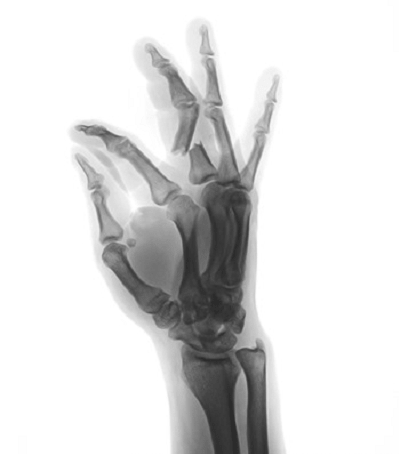 Gãy xương là nguyên nhân dẫn đến đau bàn tay