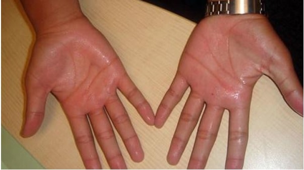 Phẫu thuật trị mồ hôi tay ra nhiều