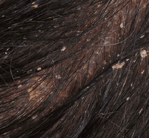 Viêm da tiết bã trên da đầu