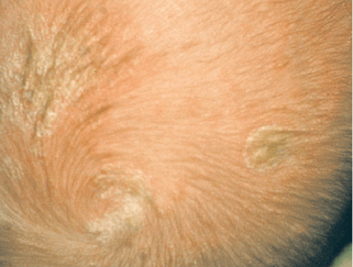 Viêm da tiết bã trên da đầu trẻ sơ sinh da trắng