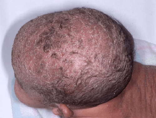 Viêm da tiết bã trên da đầu trẻ sơ sinh da đen