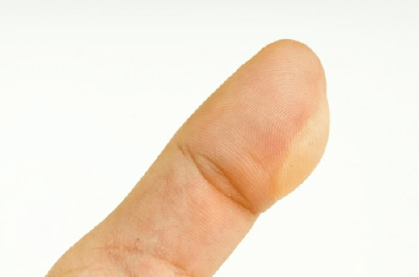 Triệu chứng mọc mụn nước
