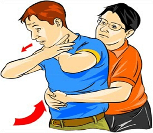 Phương pháp sơ cứu Heimlich 5 lần