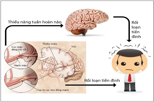 Điều trị bệnh rối loạn tiền đình