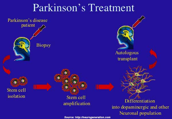 Cách điều trị bệnh Parkinson