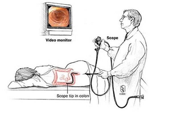 điều trị bệnh trĩ