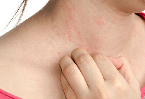 Bệnh chàm - eczema, dấu hiệu, triệu chứng và cách chữa trị