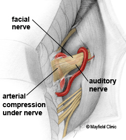 Nguyên nhân gây ra bệnh co giật nửa mặt