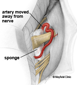 Nguyên nhân gây ra co giật nửa mặt