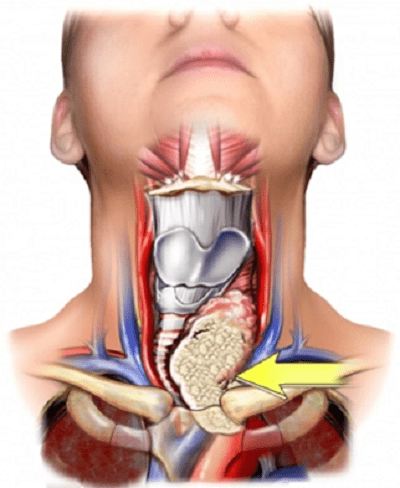Tình trạng bướu cổ cần phải mổ
