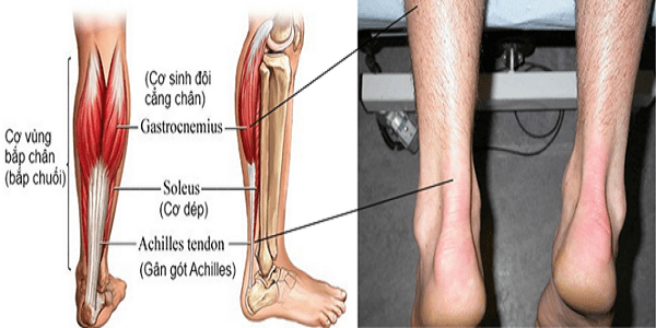 Viêm gân Achilles - nguyên nhân đau gót chân