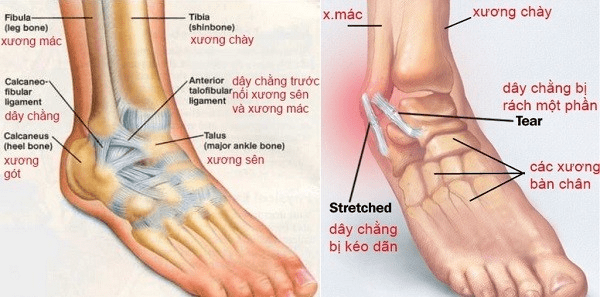 Bong gân gót chân - nguyên nhân đau gót chân