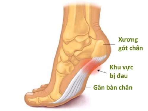 Viêm cân gan bàn chân - nguyên nhân đau gót chân
