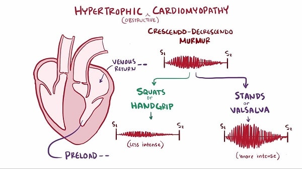 Nguyên nhân gây ra bệnh cơ tim phì đại