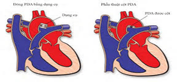 Điều trị bệnh còn ống động mạch
