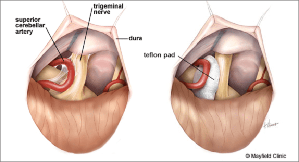 Điều trị bệnh đau dây thần kinh số V