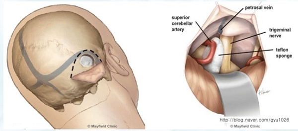 Điều trị đau dây thần kinh số V