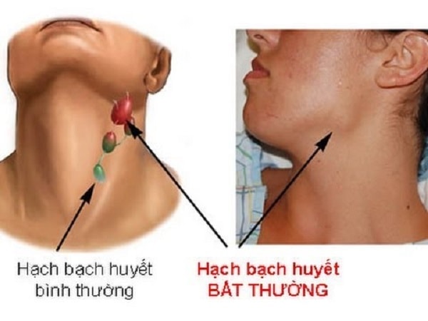 Nguyên nhân gây ra đau hạch bạch huyết