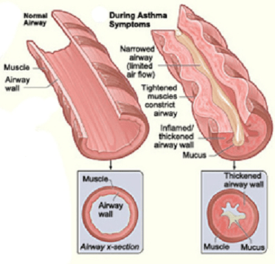 Nguyên nhân gây ra suy hô hấp cấp