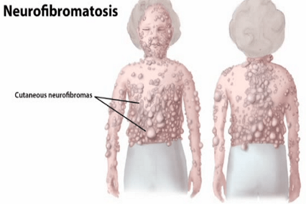 Triệu chứng bệnh u sợi thần kinh