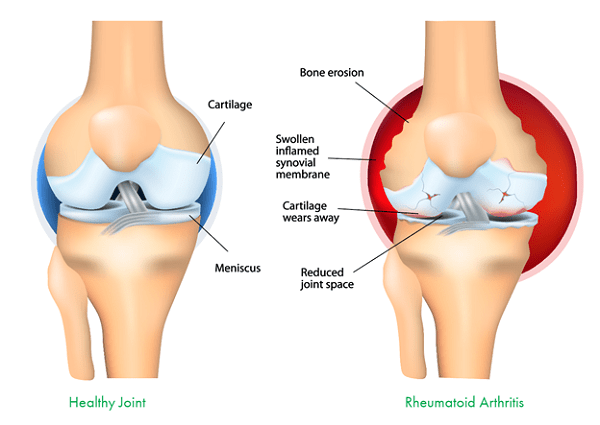Nguyên nhân gây ra đau khớp