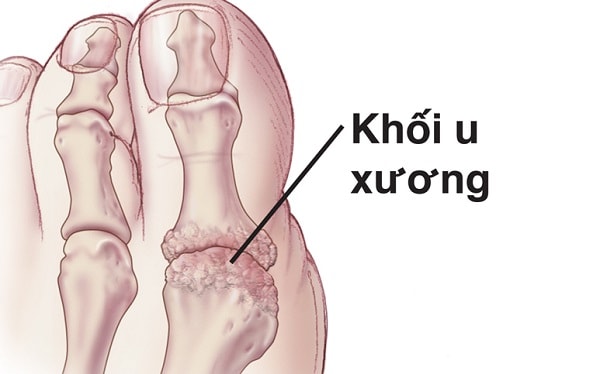 U xương - nguyên nhân đau ngón chân