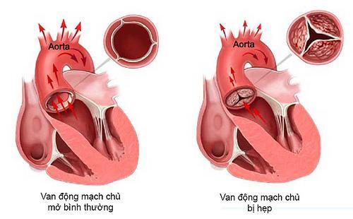 đau ngực ở trẻ em