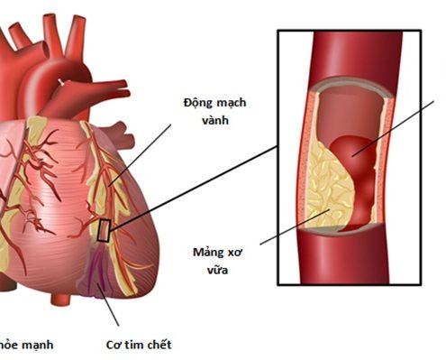 Đau ngực trái ở nam: Nguyên nhân, triệu chứng và cách điều trị