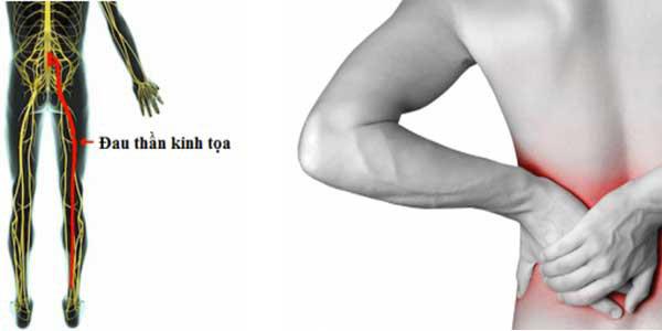 đau thần kinh tọa có nên đi bộ