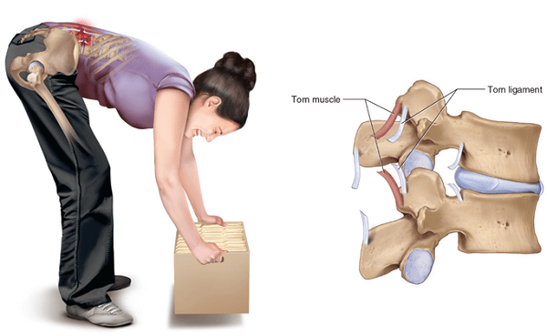 Nguyên nhân gây ra đau thắt lưng