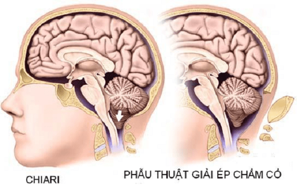 Điều trị bệnh dị dạng Chiari