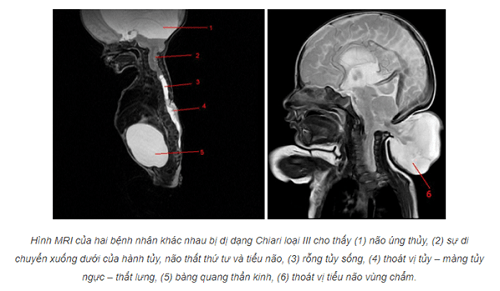 Triệu chứng của dị dạng chiari loại III