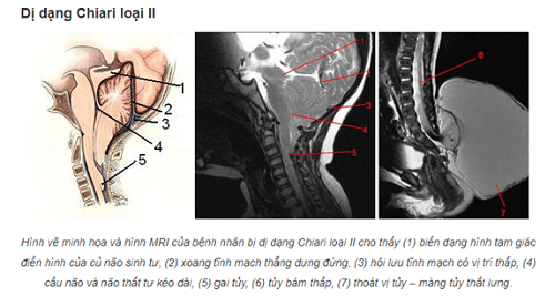 Triệu chứng của dị dạng chiari loại II