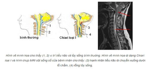 Triệu chứng của dị dạng chiari loại I