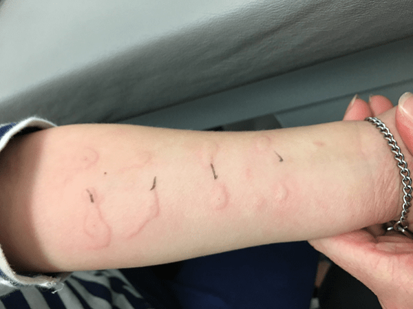 Chẩn đoán bệnh dị ứng động vật có vỏ