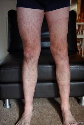 Điều trị teo cơ đùi Điều trị teo cơ đùi