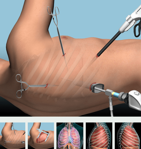 Những dạng phẫu thuật lồng ngực thường được sử dụng