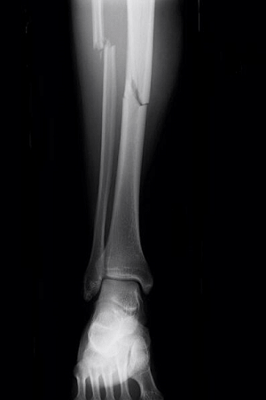 Gãy xương mác cẳng chân bao lâu thì lành và cách chăm sóc  TCI Hospital