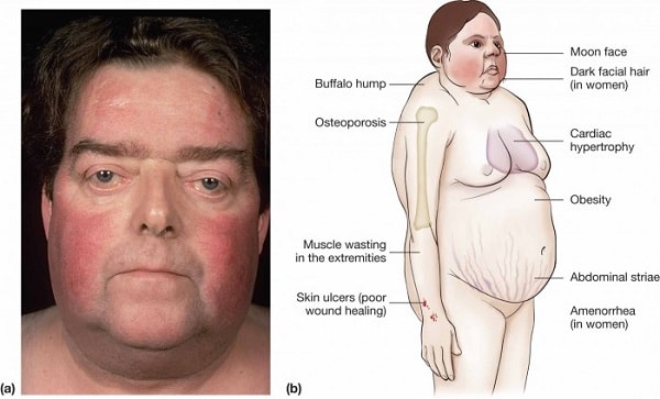Hội chứng Cushing - dấu hiệu, triệu chứng và cách chữa trị