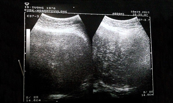 Chẩn đoán khối u bụng dựa vào hình ảnh