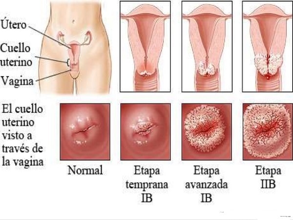 Bệnh mụn cóc sinh dục - dấu hiệu, triệu chứng và cách chữa trị