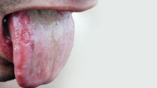 Dấu hiệu, biểu hiện và triệu chứng của bệnh nấm miệng