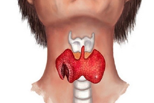 Nguyên nhân gây ra bệnh bướu cổ Nguyên nhân gây ra bệnh bướu cổ