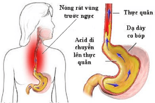 nguyên nhân bệnh trào ngược thực quản