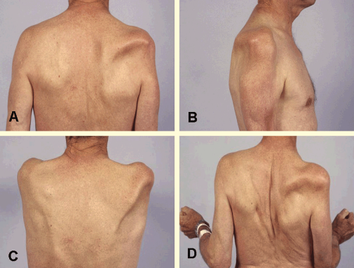 nguyên nhân teo cơ delta